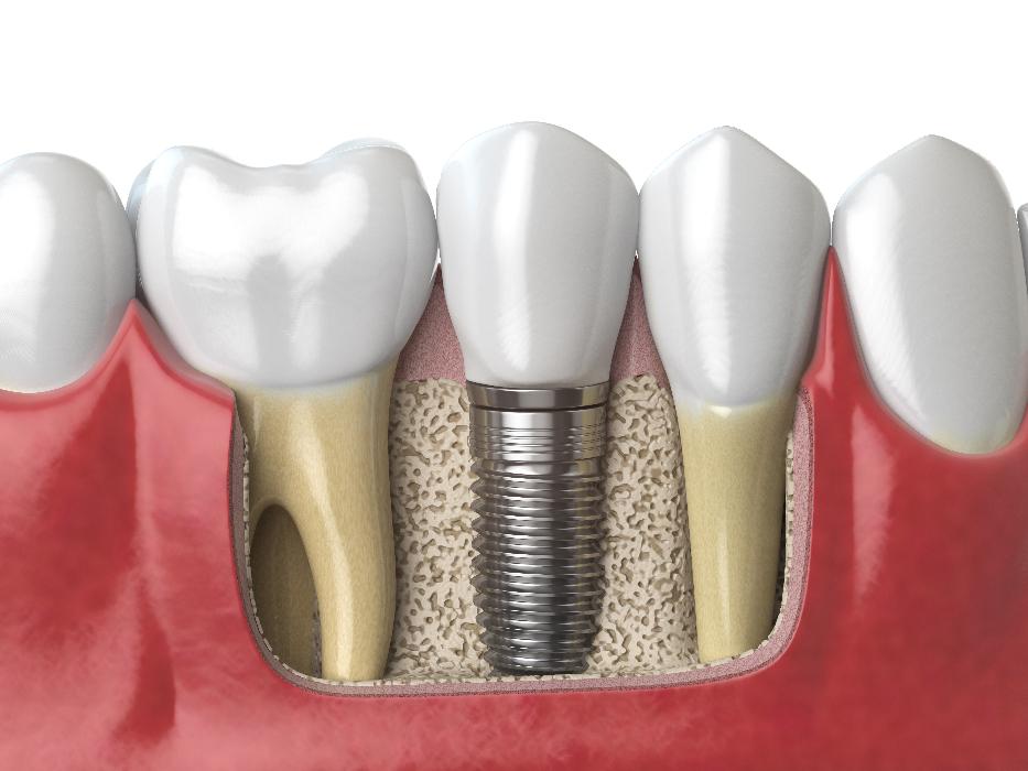 3D rendering of dental implant | dental implants sunnyvale ca