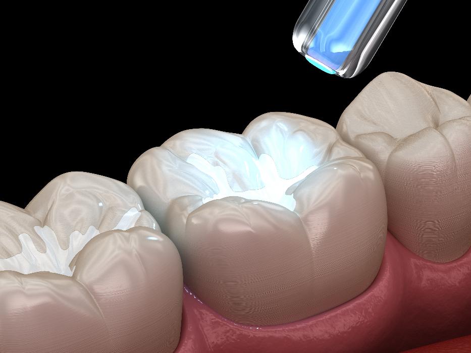 close up of dental filling | tooth colored fillings sunnyvale dentist