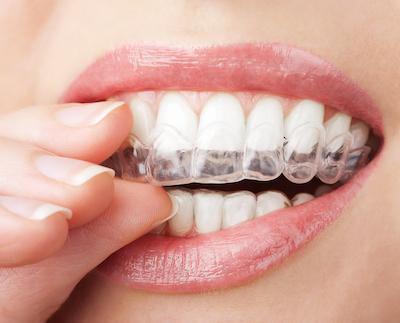 patient removing clear aligner | invisalign sunnyvale ca
