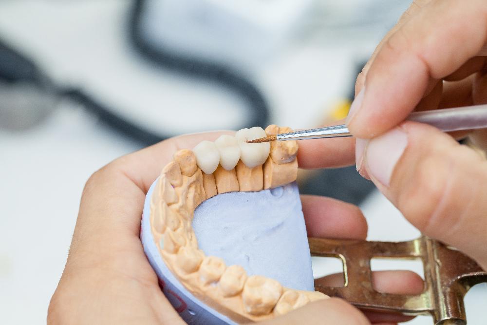 model of dental bridge in mouth | dental bridge sunnyvale ca