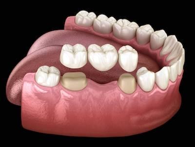 clsoe up of dental bridge | sunnyvale ca dentist
