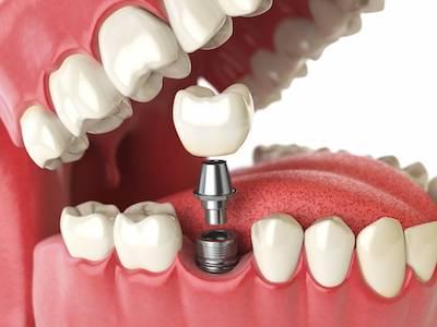 close up of dental implant | dental implants sunnyvale