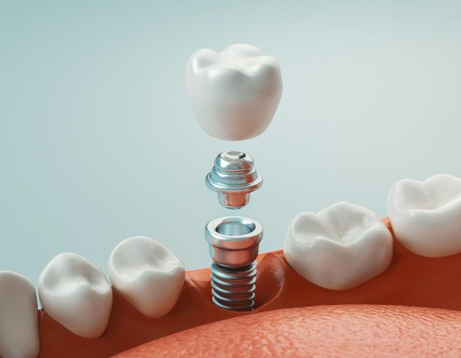 dental implant in three pieces | dental implants sunnyvale ca