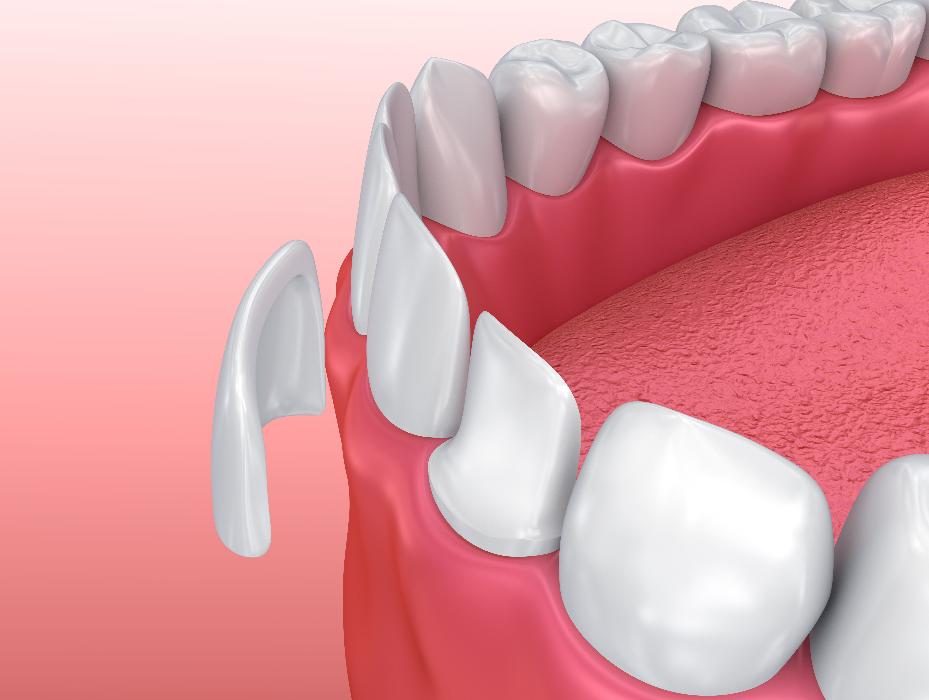 dental veneer illustration | veneers sunnyvale ca