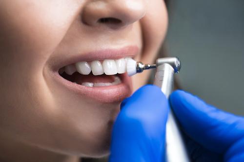patient receiving tooth polish | dentist in sunnyvale ca