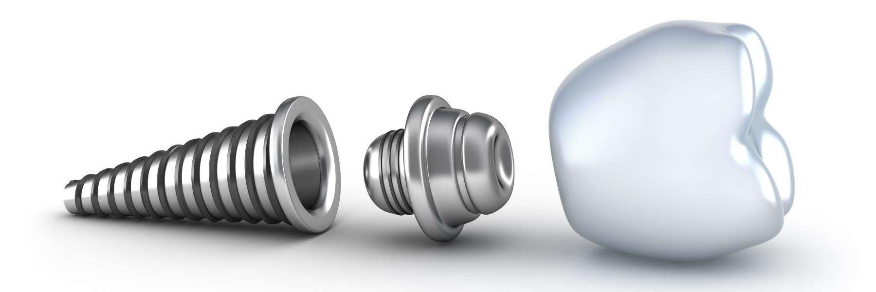 close up of dental implant | dentist sunnyvale ca
