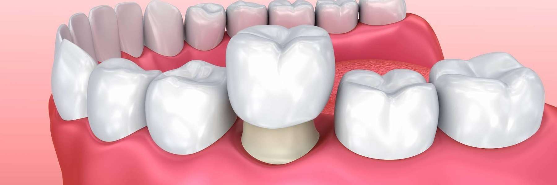 close up of dental crown on tooth | dental crowns sunnyvale ca