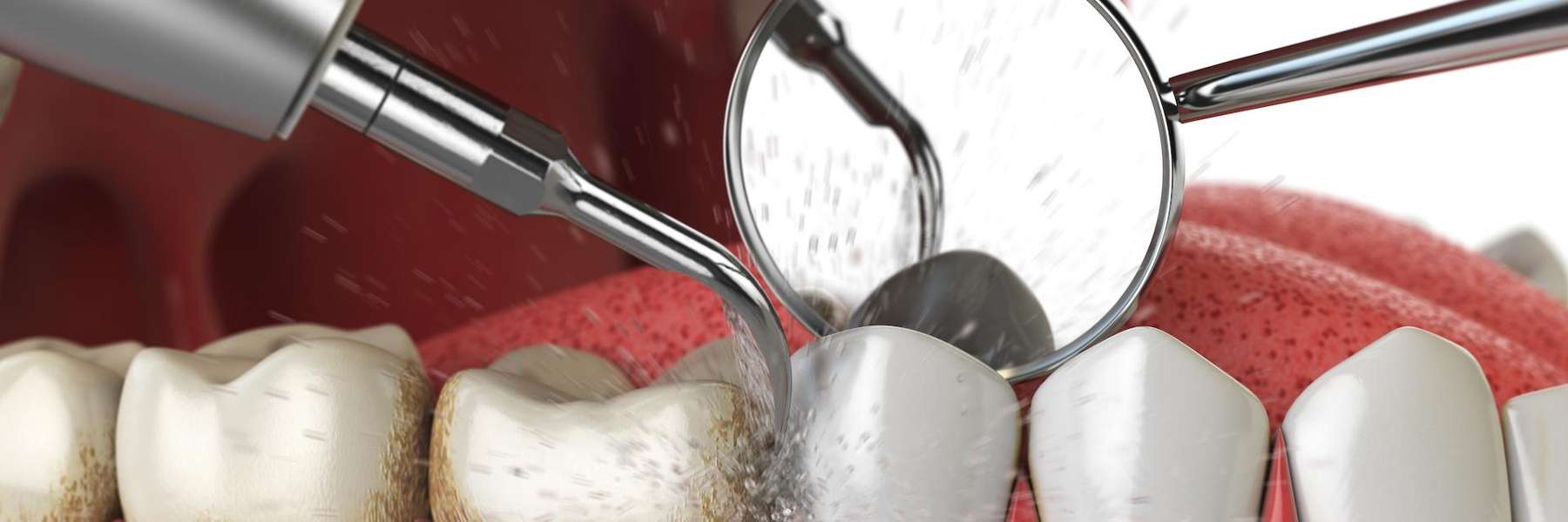 close up of dental tools | sunnyvale ca dentist