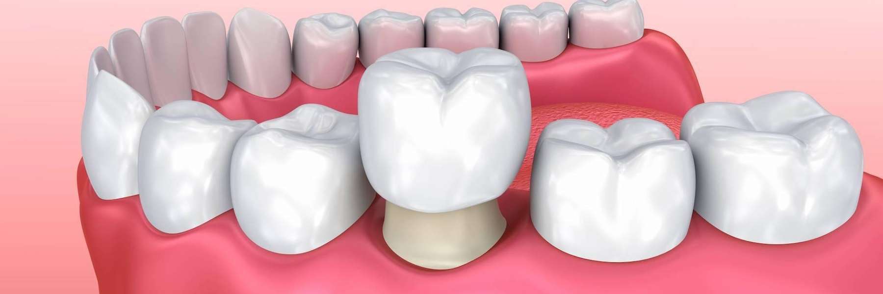 close up of dental crown in mouth | cosmetic dentistry sunnyvale ca