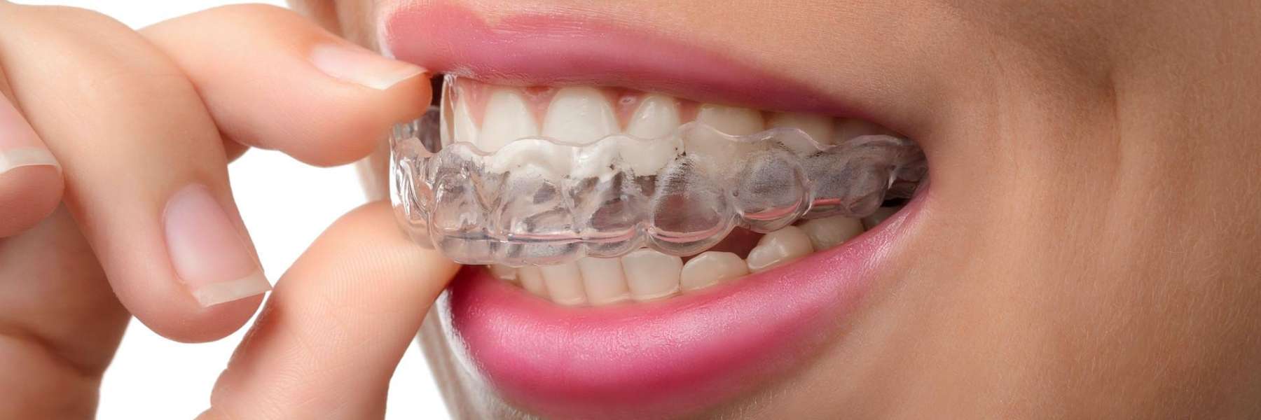 patient putting in clear plastic aligner | invisalign dentist sunnyvale