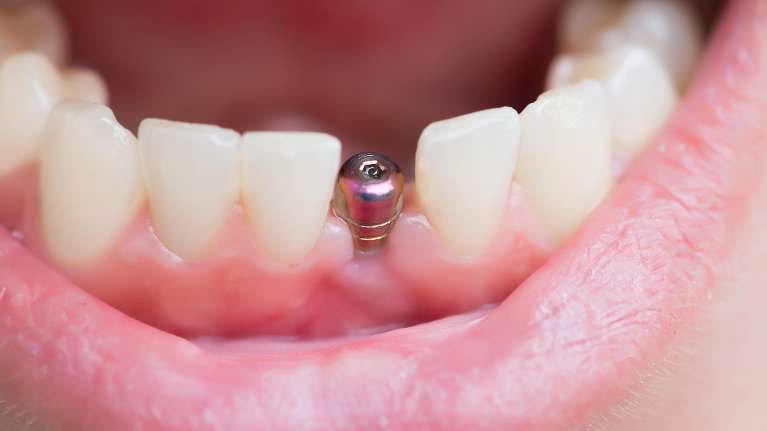 close up of dental implant | dental implants sunnyvale ca