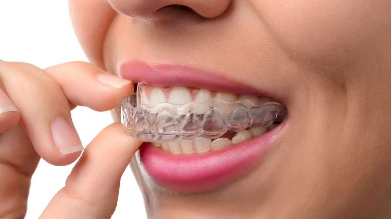 patient putting in clear plastic aligner | invisalign dentist sunnyvale