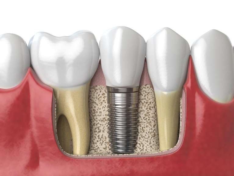 3D rendering of dental implant in jaw | dental implants sunnyvale