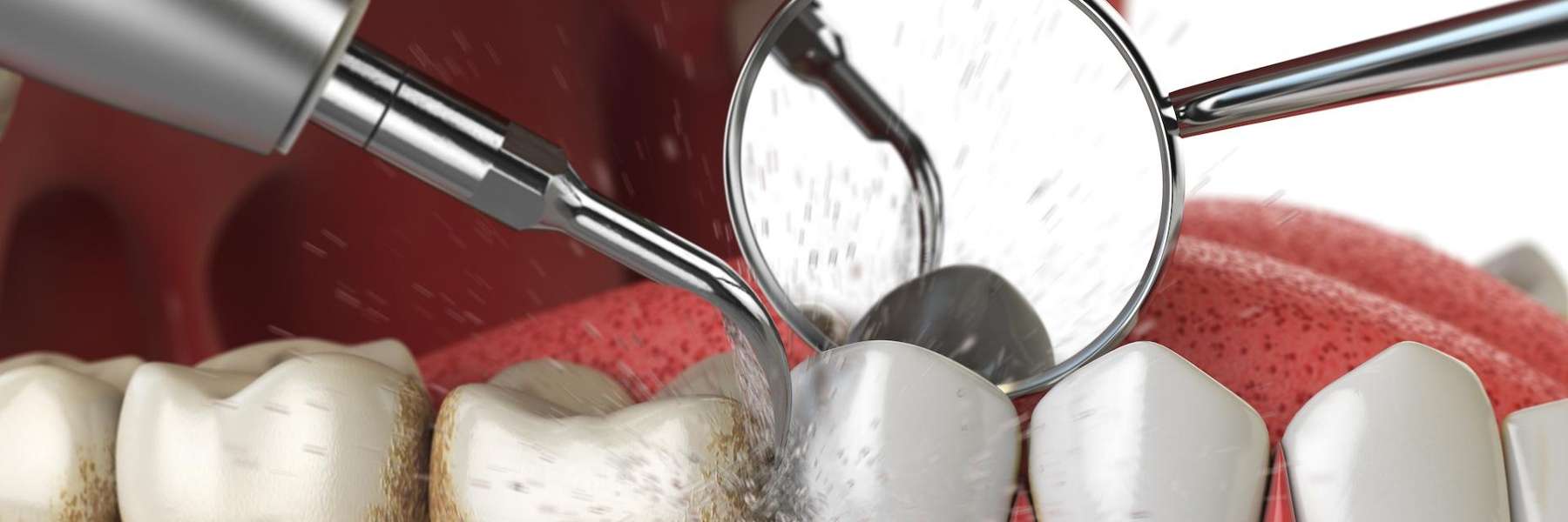 dental tool close up during exam | dentist sunnyvale ca