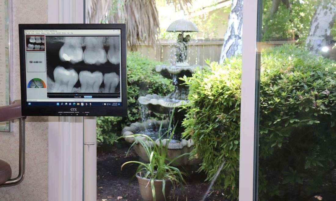 close up of dental x-ray | dental x-ray sunnyvale ca