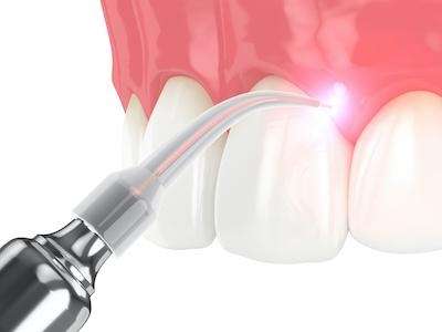 3D rendering of laser dentistry | dds sunnyvale